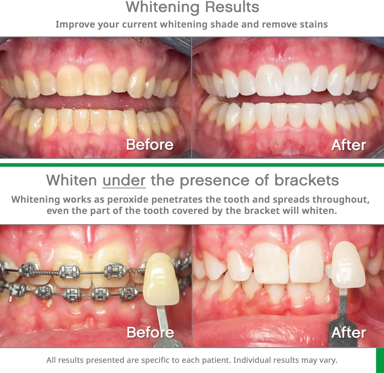 Opalescence Go 15- Prefilled Teeth Whitening Trays - 15% Hydrogen Peroxide - (10 Treatments) Made by Ultradent Products. Teeth Whitening Kit -Mint - 5194-1